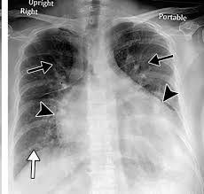 Multisystem Imaging Manifestations Of Covid 19 Part 2 From Cardiac Complications To Pediatric Manifestations Radiographics
