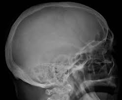 Find more information on clinical trials that are open for enrollment at mount sinai's center for excellence for multiple myeloma. The Role Of The Bone Marrow Mesenchymal Stem Cell In Mgus And Multiple Myeloma