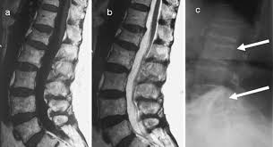 Ossification of spinal ligaments, paravertebral soft tissue, disk spaces can occur The Spine In Paget S Disease Springerlink