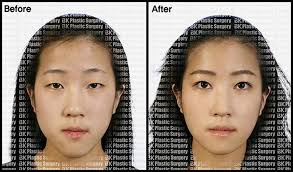 With the rise of “lookism” in south korea, plastic surgery has grown from a subculture into a mainstream culture that penetrated deeply into the society. Bk Plastic Surgery In Republic Of Korea Treatment Cost And Verified Reviews Bookimed