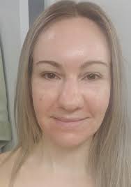 I Tried It: The Photofractional Facial