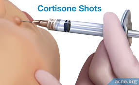 Image result for Injectable Corticosteroid