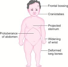 Image result for Craniotabes