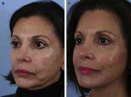 Midface Volumization with Injectable Fillers