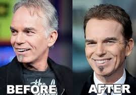 Billy Bob Thornton Hair Transplant Celebrity Surgery Plastic Surgery Photos Hair Transplant