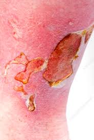 Image result for Lipodermatosclerosis