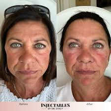 Fall Skincare Routine Refresh: Chemical Peels and Microneedling