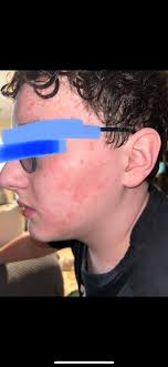 Medication for itchy chin acne that bleeds