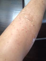 I Knew I Had Lymphoma Cancer And The Doctors Did Not Listen