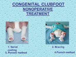 Ponseti established the method in the 50s. Congenital Clubfoot Congenital Clubfoot Nonoperative Treatment 1 Serial Casting 2 Bracing 3 Ponseti Method 4 French Method Ppt Download