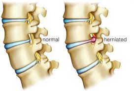 Dr mahyuddin mohamed 7 months ago. Cara Alternatif Rawat Slipped Disc Cepat Dan Berkesan