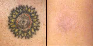 The only thing that will be left behind after your picoway laser tattoo removal sessions is smooth, clean skin that is totally free of that unwanted tattoo. Will Tattoo Removal Leave A Scar Authoritytattoo