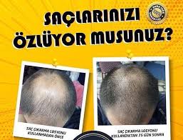 New The 10 Best Hairstyles With Pictures Sac Cikaran Losyonumuz Kesin Sonuc Veriyor Ilk 1 Ayda Kellik Bitti Diyebiliriz Baseball Cards Playbill Cards