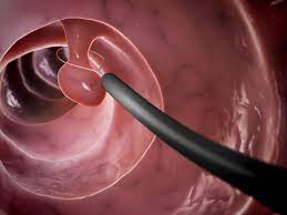 In the second example below, an em dash is more common than a colon, though the use of a colon is nevertheless correct. Colon Polyp Symptoms Causes Diagnosis Treatment