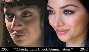 Before And After Cosmetic Surgery Plastic Surgery Cosmetic Surgery Cheek Implants