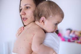 Your baby's sensitive skin needs special care every day. Baby Acne Causes Diagnosis And Treatment