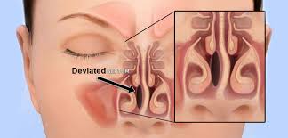 Septum Deviasyonu Nedir Septum Rinoplasti