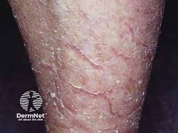 Image result for Ichthyosis