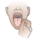 Image result for what is the treatment for vocal cord paralysis