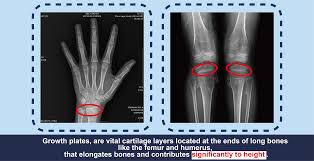 Image result for Growth Plate