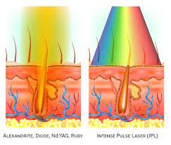 Flash electrology permanent hair removal. Laser Hair Removal Versus Electrolysis Hair Removal Beware Of Laser Hair Removal