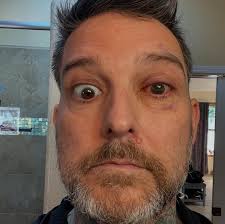 Eyeball update. Of COURSE I made a new eye patch and of COURSE I added a  googly eye to it. Duh. WARNING; the additional slide show my actual eye,  it's a little