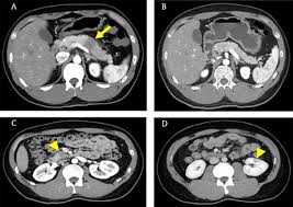 A ct scan helps doctors make a pancreatic cancer diagnosis. Pancreas Ductal Adenocarcinoma And Its Mimics Review Of Cross Sectional Imaging Findings For Differential Diagnosis
