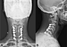 SciELO Brasil - Cervical Myelopathy Secondary to Gout: Case Report Cervical  Myelopathy Secondary to Gout: Case Report