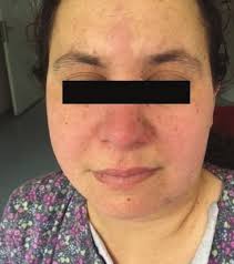 A Rare Case of Lupus Lymphadenopathy in the Differential Diagnosis of  Lymphadenopathy