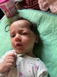 Has anyone experienced a swollen eye suddenly worsening?