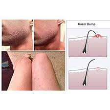 Ingrown hairs are bumps that contain trapped hair. Buy Safecut Dr A Z Anti Razor Bump Ingrown Hair Formula 125ml For Women Men Best Treatment For Ingrown Hairs Acne Razor Bumps Razor Burn Use After Shaving Waxing Electrolysis