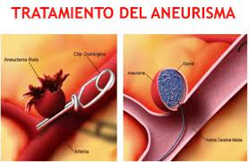 Rupture of a cerebral artery it results in the destruction of nerve cells as well as the formation of a hematoma. Aneurisma Cerebral Que Es Tipos Sintomas Causas Secuelas Y Mas