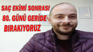 Sac Ekimi Oncesi Sonrasi 80 Gunu Geride Biraktik Youtube