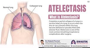 Mucus that plugs the airway, foreign objects in the airway (common in children) and tumors that obstruct the airway may lead to atelectasis. Atelectasis Hashtag On Twitter