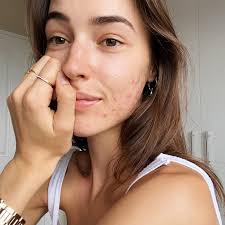 7 Acne Positive Influencers You Should Follow ASAP