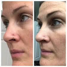 Do gluten cause tattoo inflammation?