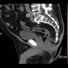 Se decidete di affrettare il vostro iter medico e sottoporvi ad una risonanza magnetica presso uno studio. Tac Addome Inferiore O Pelvi Chirofisiogen Center