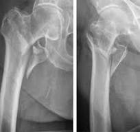 TFN-ADVANCED Proximal Femoral Nailing System (TFNA)