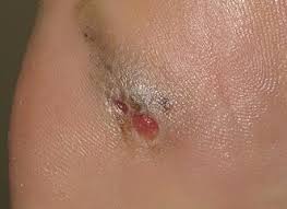 This is known as a clotted skin tag, or thrombosed. Can Skin Cancer Look Like A Blood Blister