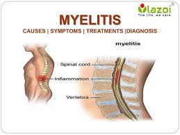 Image result for Myelitis