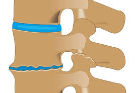 Osteochondrose Symptome Ursachen Und Behandlung Heilpraxis