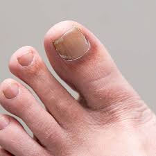 Image result for onychomycosis
