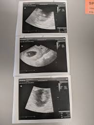 Twins can be diagnosed when ultrasound discovers more than one. 7 Week Ultrasound Monochorionic Multiples And Twins Forums What To Expect