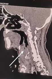 Image result for Stridor