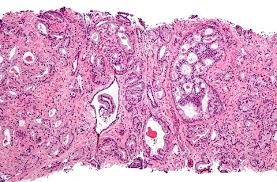 Some men are at increased risk for prostate cancer. Sophiris Slides On Prostate Cancer Data But Vows To Press On Fiercebiotech