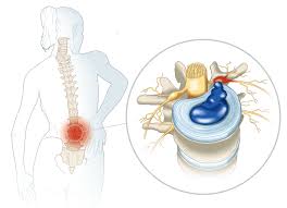 Image result for vyhřezlá ploténka