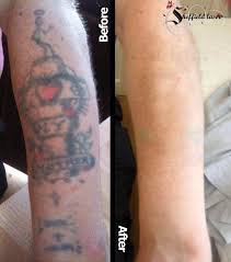 Appointments are relaxed but always professional and if you have any first time nerves, jordan will make you feel at ease and explain everything. Tatto Wallpapers Tattoo Removal Sheffield