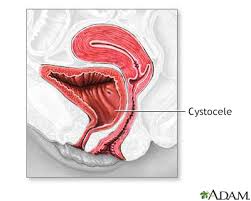 V stands for vaginal vestibule, the opening of the vagina, or the area just before entering the canal, right past the labia minora (inner lips). Anterior Vaginal Wall Repair Information Mount Sinai New York