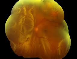 Image result for Retinal Detachment