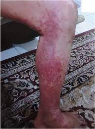 Maybe you would like to learn more about one of these? Black Box Warning Rash With Entecavir Case Report Bmc Gastroenterology Full Text